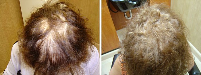 Laster Hair Therapy Before & After Client 2