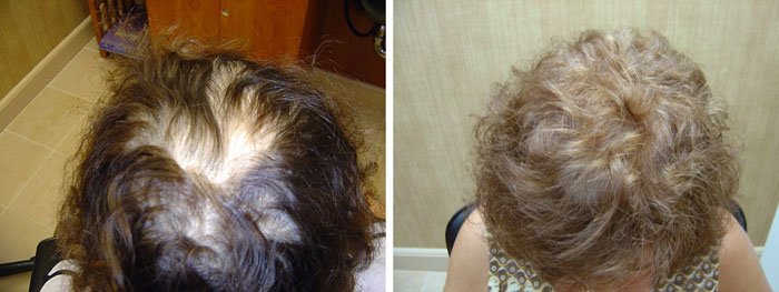 Laster Hair Therapy Before & After Client 3