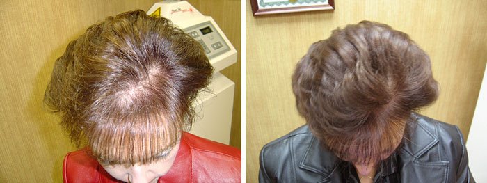 Laster Hair Therapy Before & After Adele