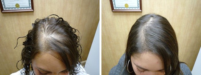 Laster Hair Therapy Before & After Alex