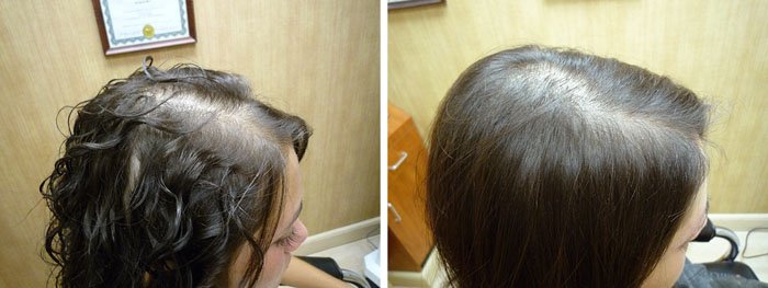 Laster Hair Therapy Before & After Alex 2