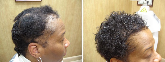 Laster Hair Therapy Before & After Alice 2