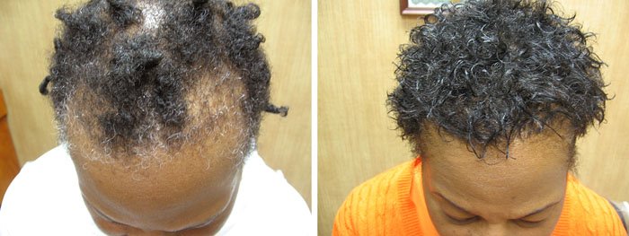 Laster Hair Therapy Before & After Alice