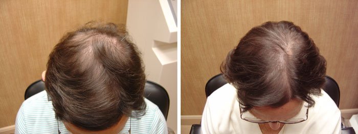 Laster Hair Therapy Before & After Client 6