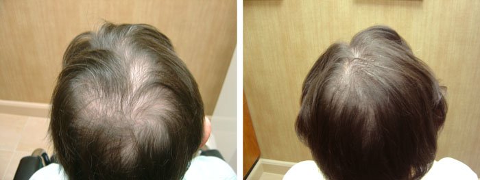 Laster Hair Therapy Before & After Client 7