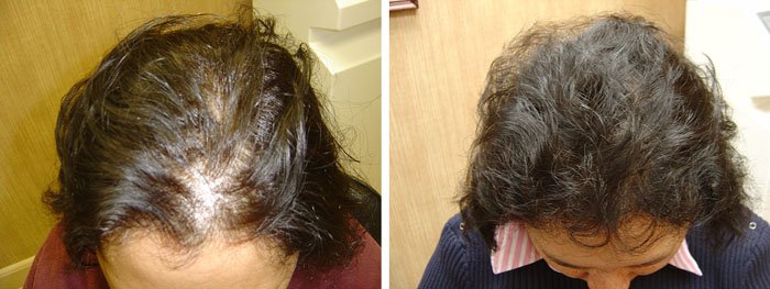 Laster Hair Therapy Before & After Anna