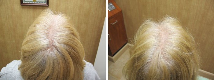 Laster Hair Therapy Before & After Cathy