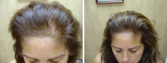 Laster Hair Therapy Before & After Flor