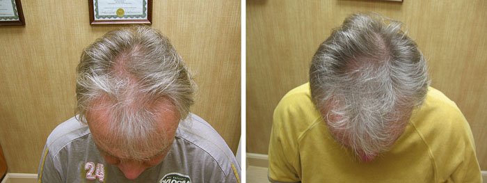 Laster Hair Therapy Before & After Frank