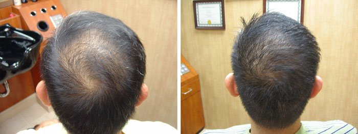 Laster Hair Therapy Before & After Henry