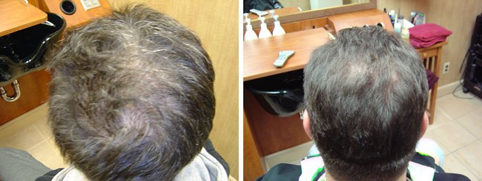 Laster Hair Therapy Before & After John