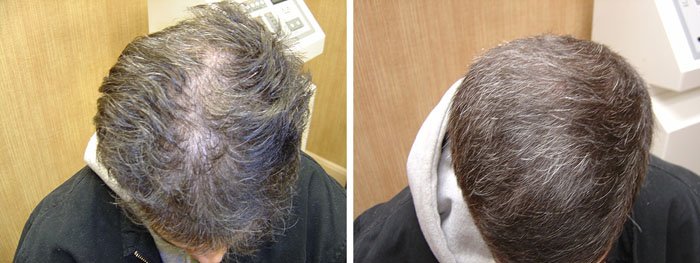 Laster Hair Therapy Before & After John 2