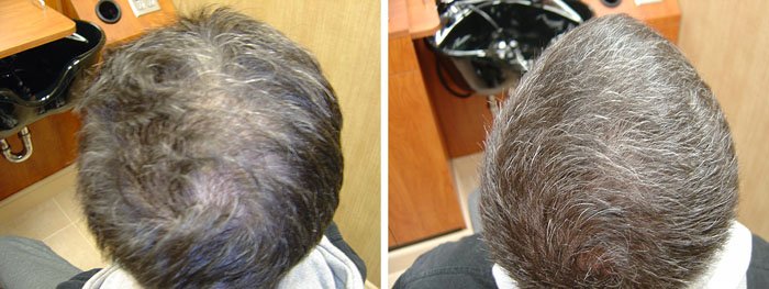 Laster Hair Therapy Before & After John 3