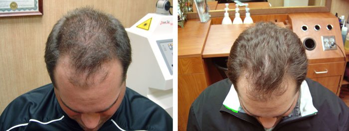Laster Hair Therapy Before & After Mark