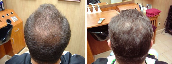 Laster Hair Therapy Before & After Mark 2
