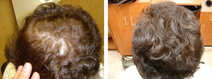 Laster Hair Therapy Before & After Client 1