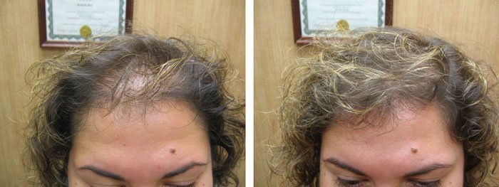 Laster Hair Therapy Before & After Rosa 1
