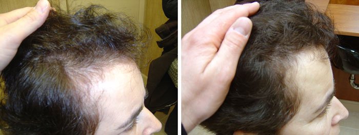 Laster Hair Therapy Before & After Rosa 2