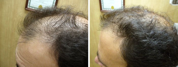Laster Hair Therapy Before & After Tony 1