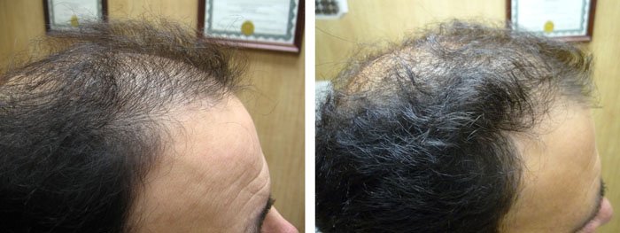 Laster Hair Therapy Before & After Tony 2