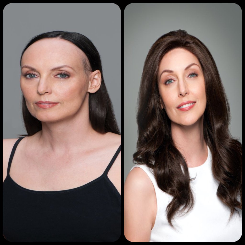 Hair Restoration Before And After Photo - Female 1
