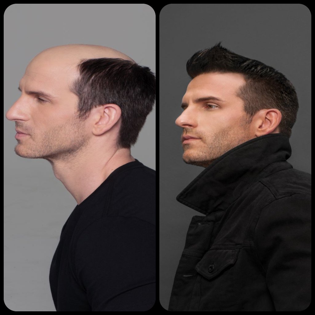 Hair Restoration Before And After Photo - Male 2