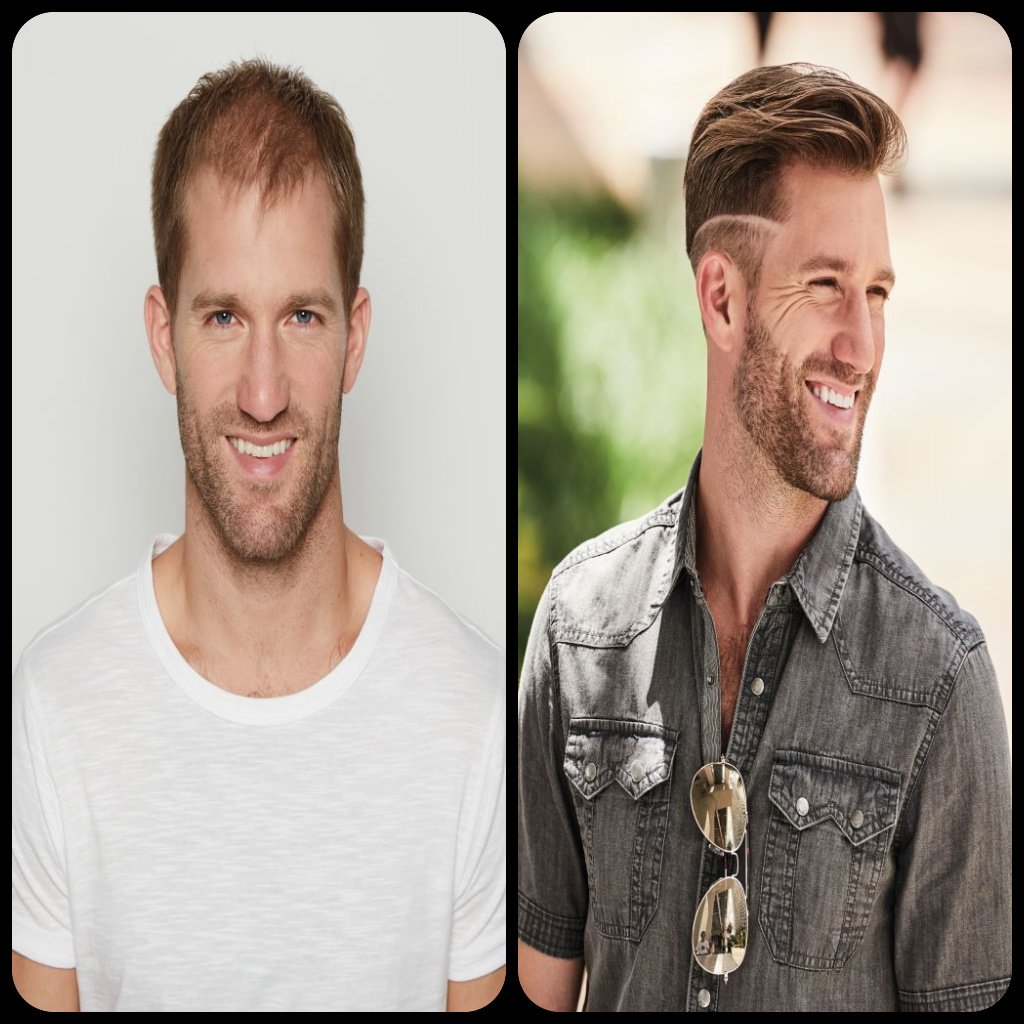 Male Hair Restoration Before and After Man 3