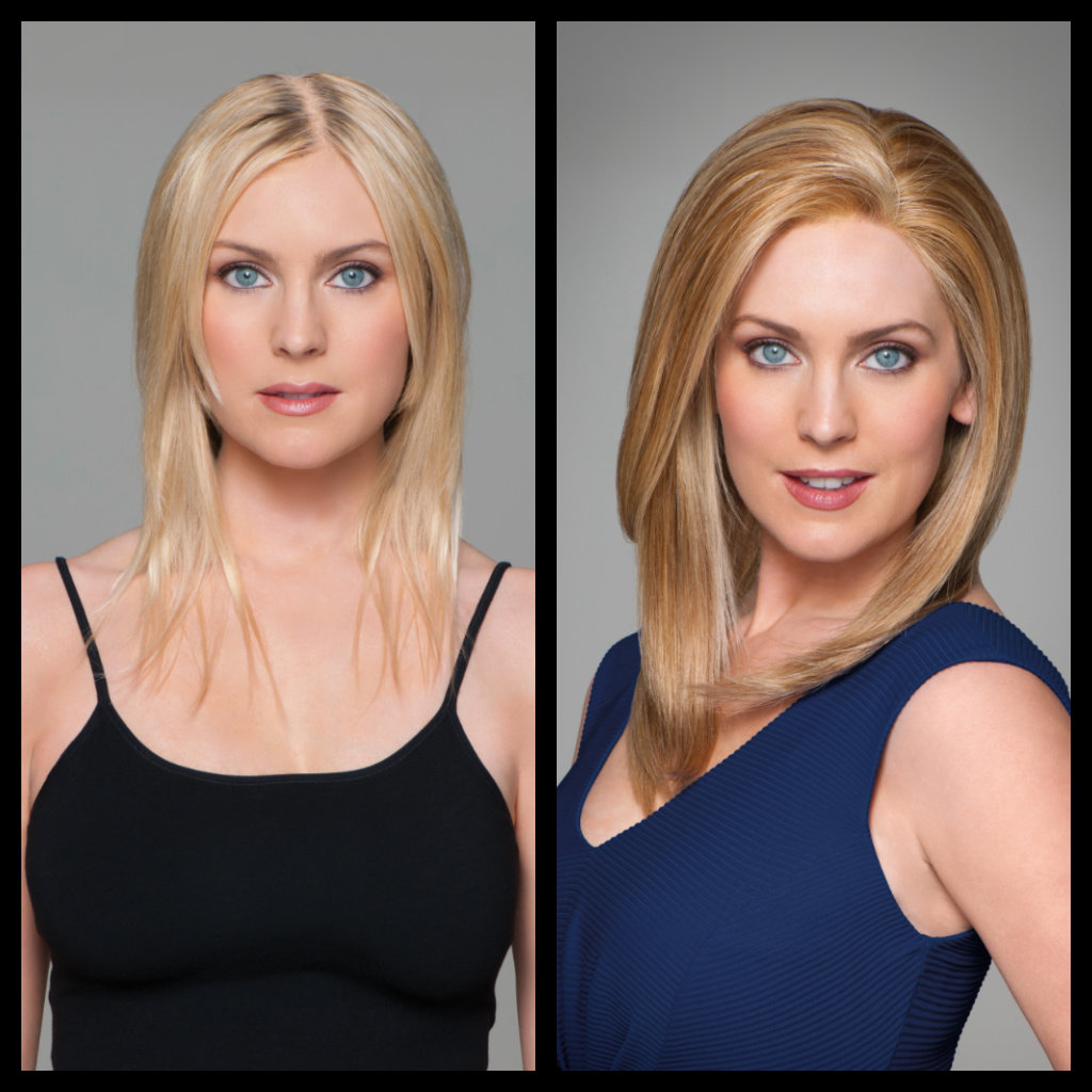 Hair Restoration Before And After Photo - Female 4