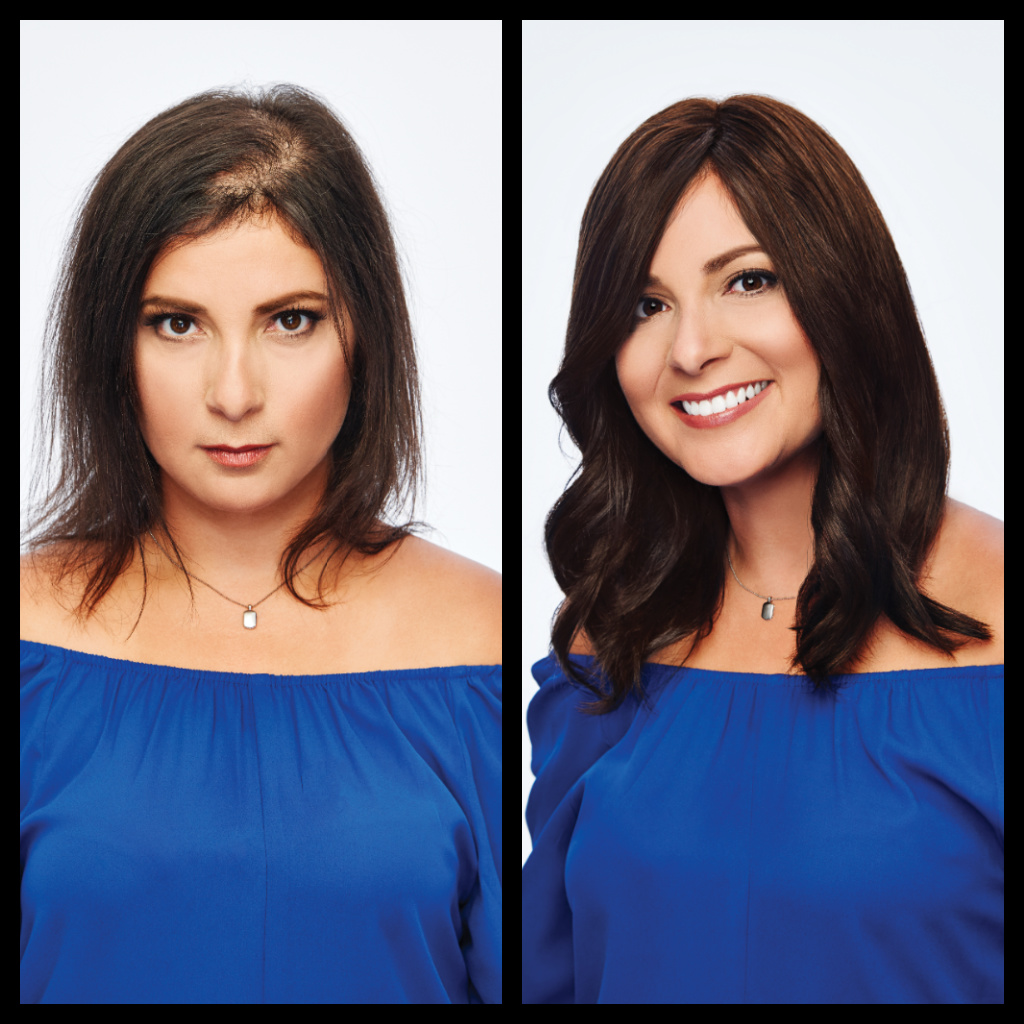 Female Hair Restoration Before and After Woman 2