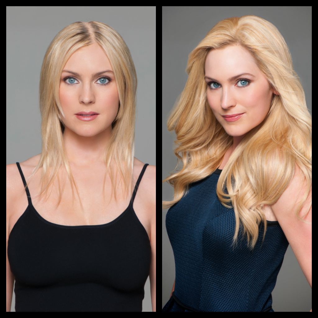 Female Hair Restoration Before and After Woman 1