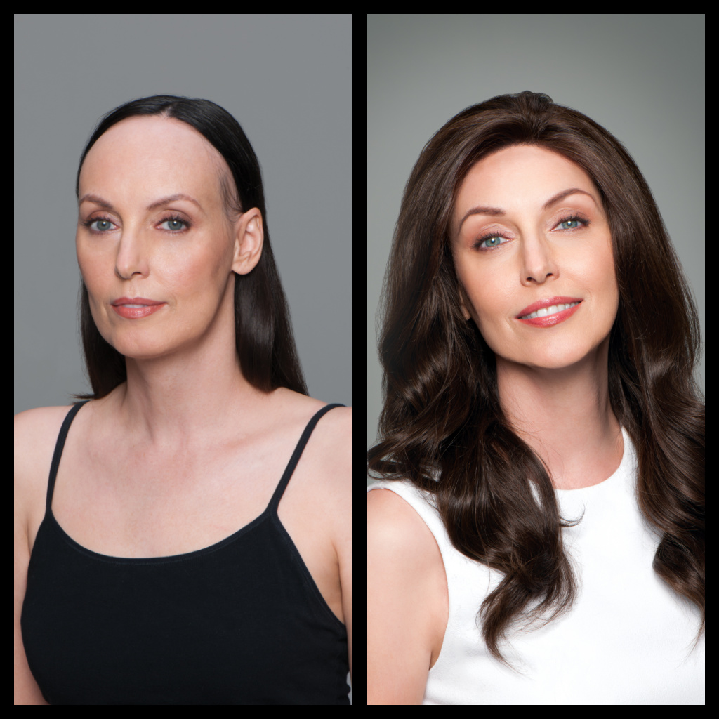 Female Hair Restoration Before and After Woman 3