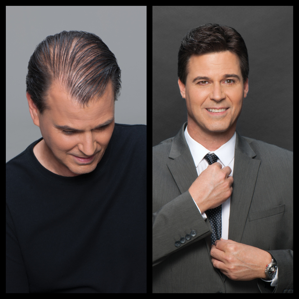 Hair Restoration Before And After Photo - Male 3