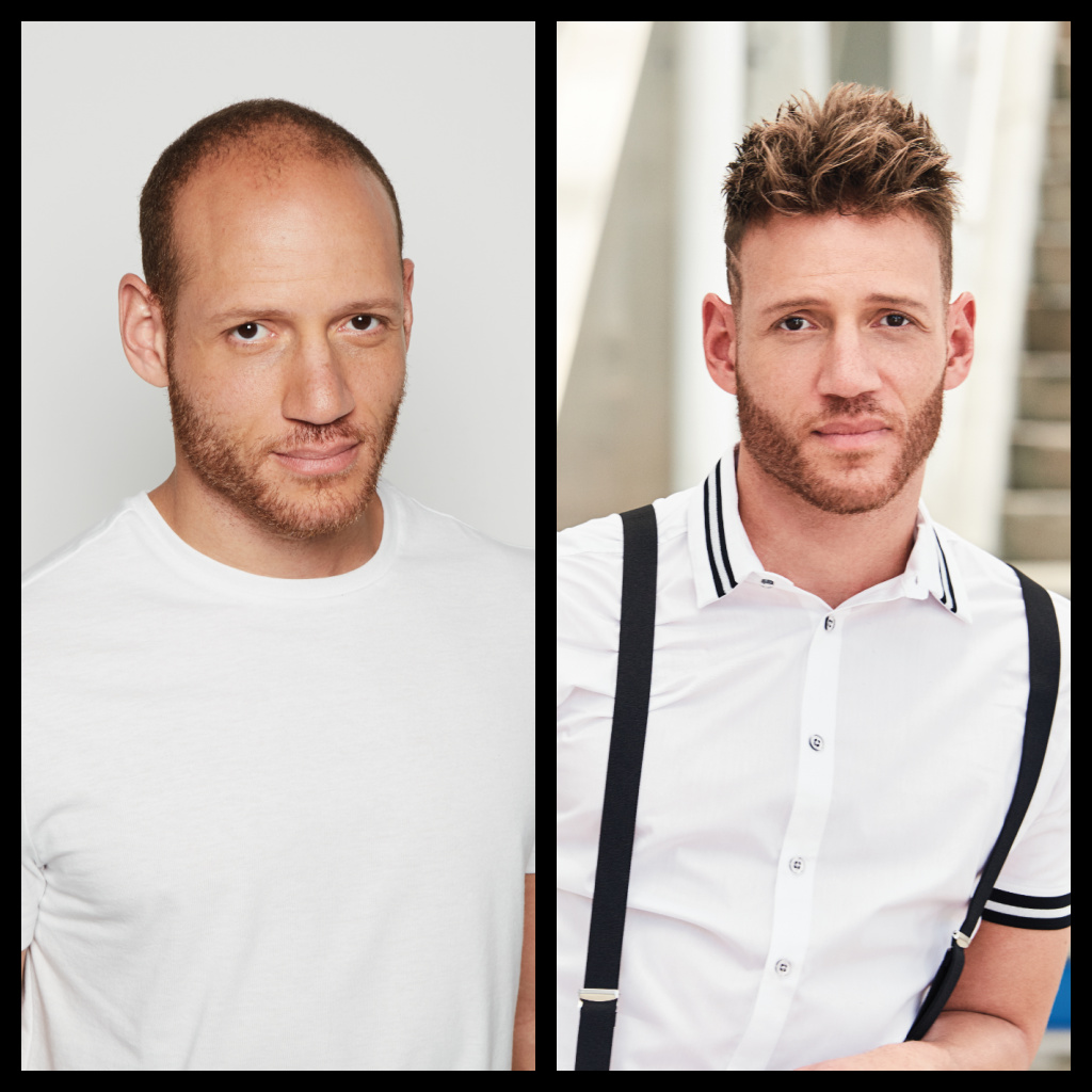 Male Hair Restoration Before and After Man 2