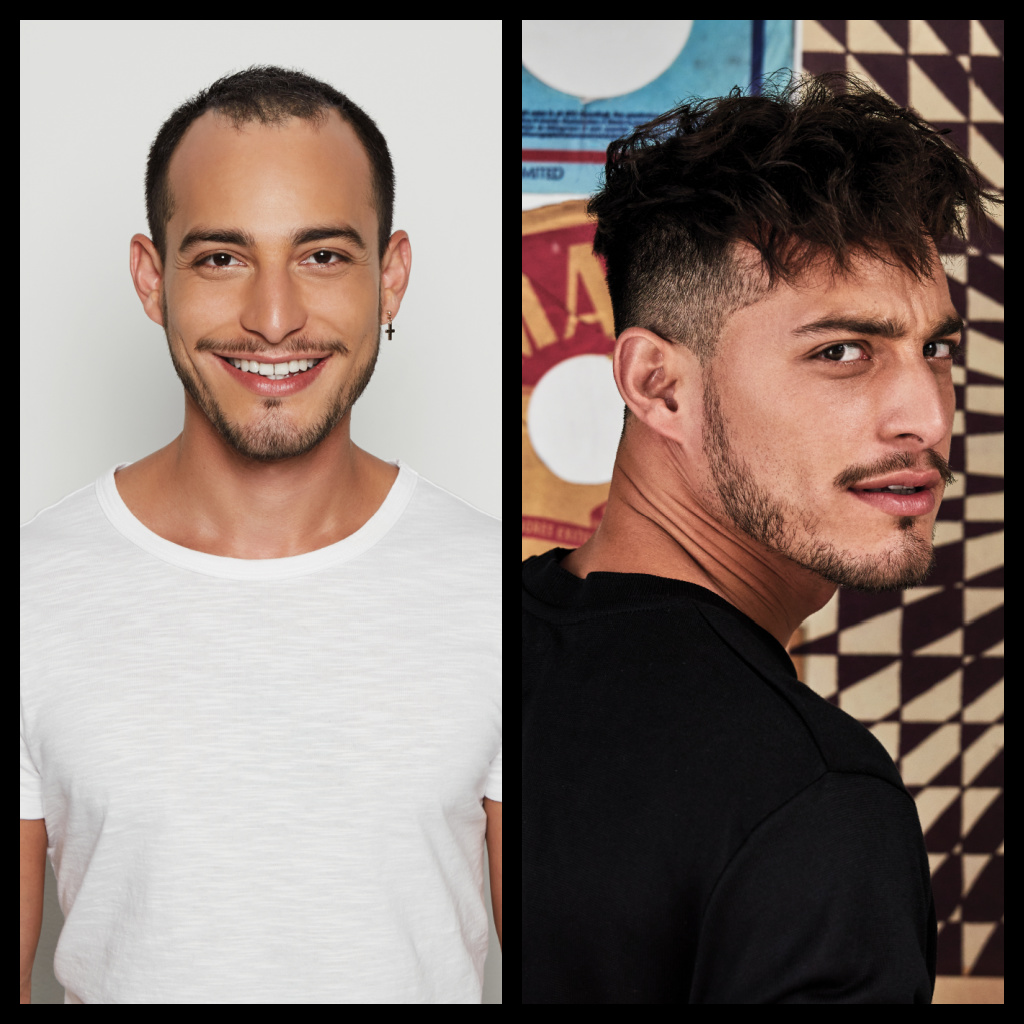 Male Hair Restoration Before and After Man 1