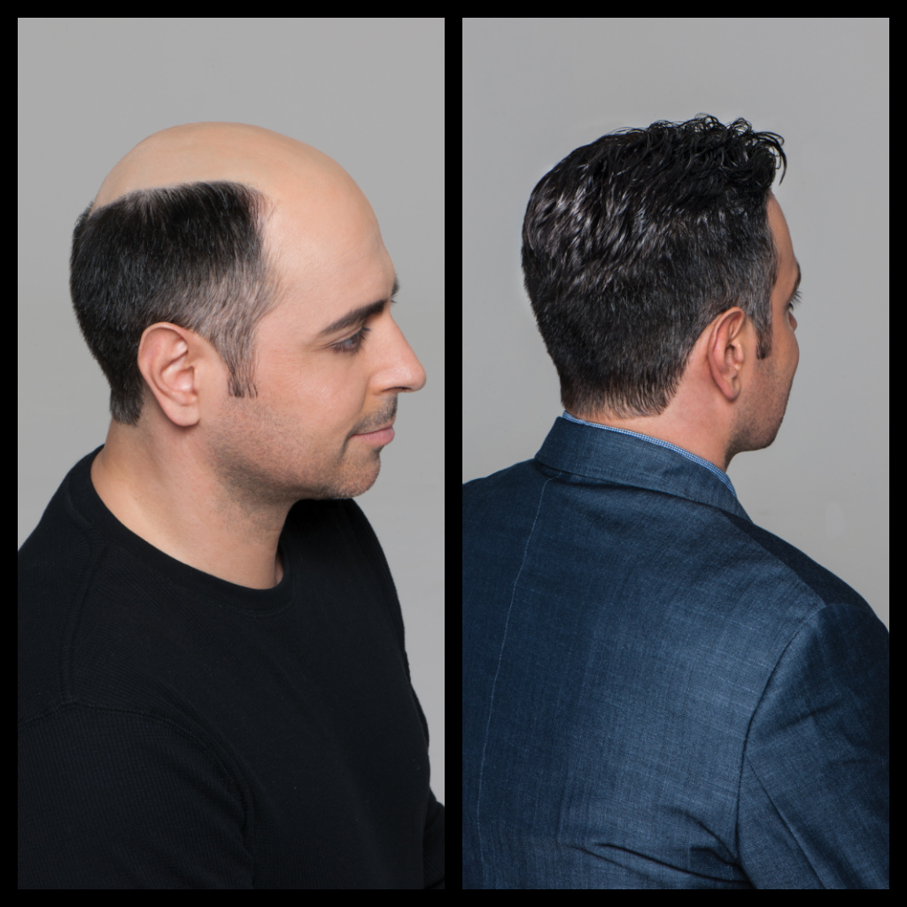 Hair Restoration Before And After Photo - Male 7