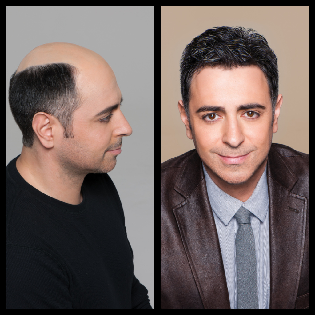 Male Hair Restoration Before and After Man 4