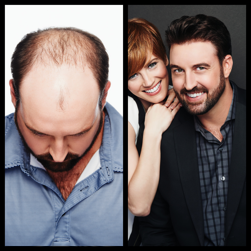 Hair Restoration Before And After Photo - Male 1
