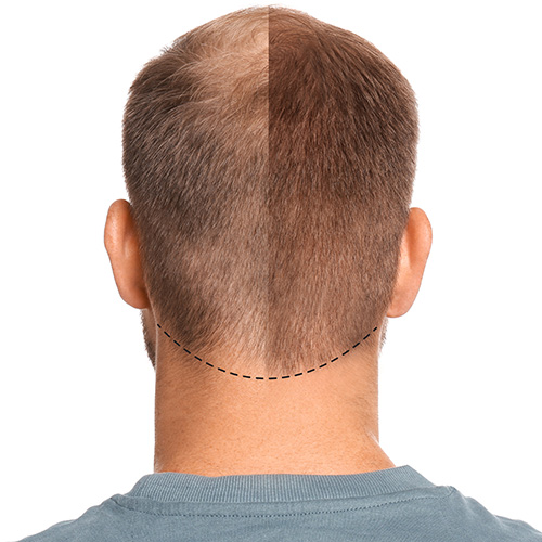 Before & After Laser Hair Therapy. A closeup of the back of a man's head showing before and after results.