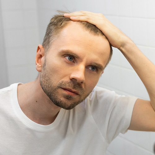 Hair Loss Male Pattern Baldness. A man holds his hair back and looks at his receding hairline.
