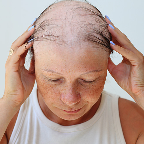 Hair Loss From Alopecia Areata. A woman places her hands on her head. Only a few stands of hair remain.
